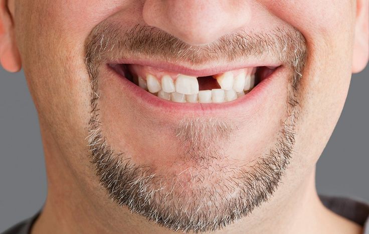 «El Síndrome del Impostor Dental»: Por qué recuperar un diente perdido es más una cuestión mental que física