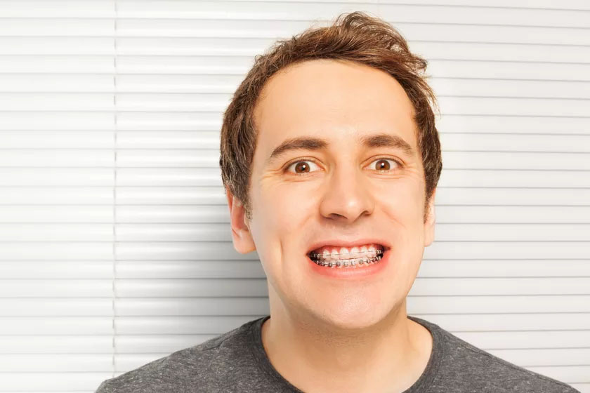 El fenómeno de los «Brackets Ejecutivos»: Por qué en España la ortodoncia es el nuevo reloj de lujo