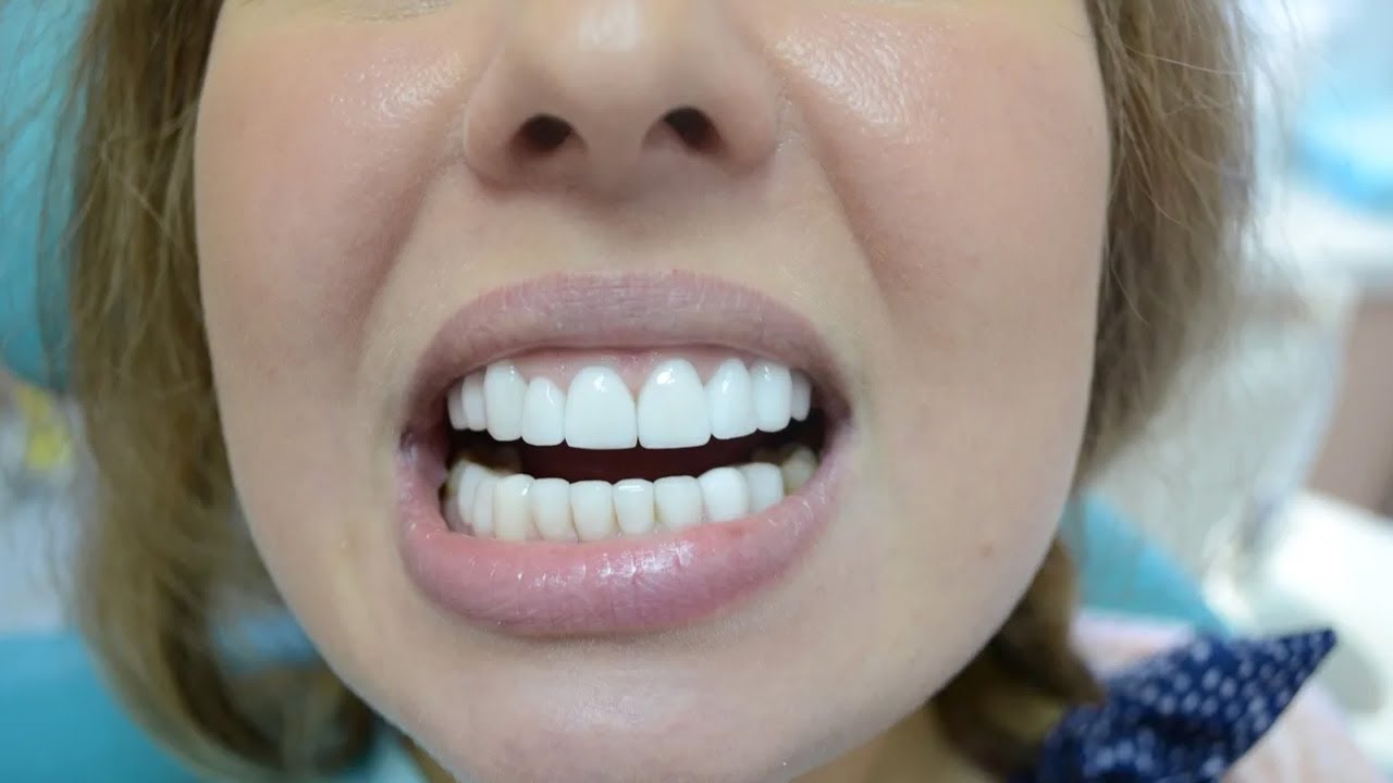 El coste oculto de lo «barato»: Por qué tu sonrisa no debería tener precio de rebajas